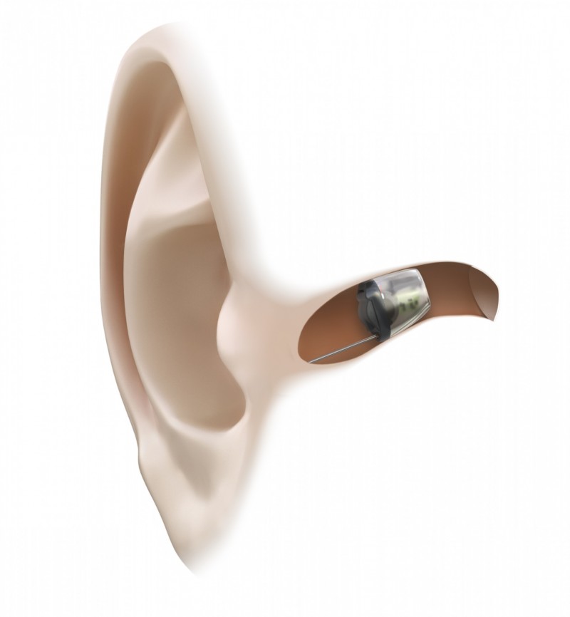 Слуховые аппараты бывают. Глубококанальные слуховые аппараты IIC. Слуховые аппараты невидимые внутриушные. Внутриканальный слуховой аппарат невидимый. Слуховой аппарат лот 41319.